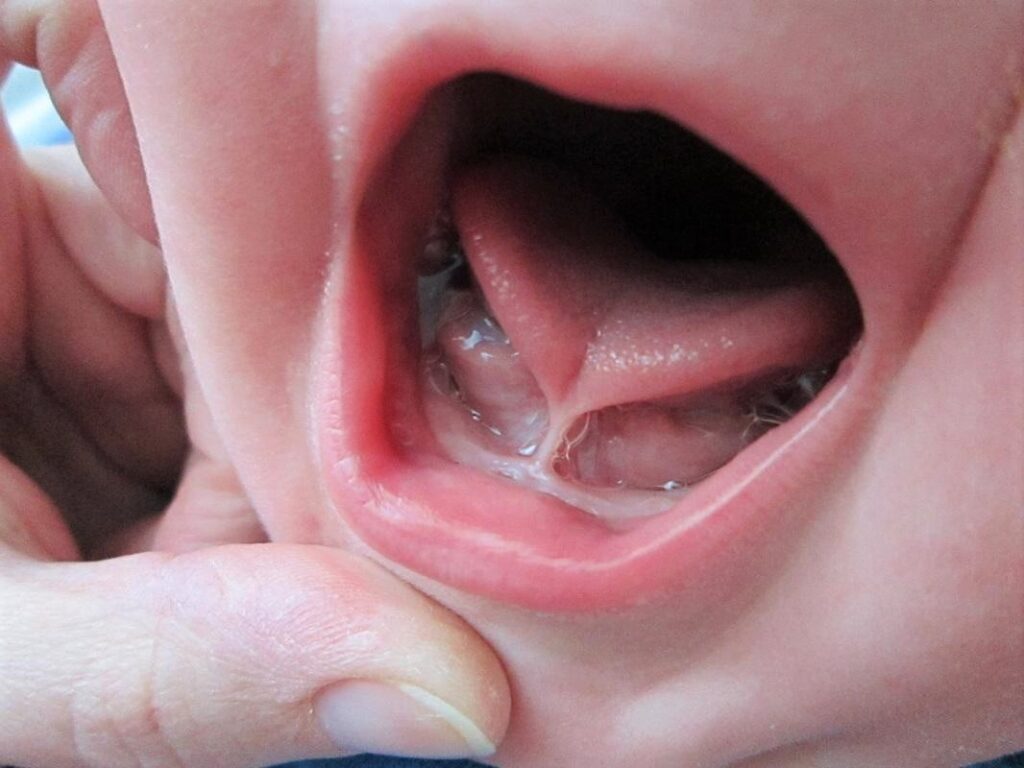 Cirurgia da linguinha (frenectomia lingual) em bebês e crianças realizada pela Dra. Daniele Tavares na Tijuca